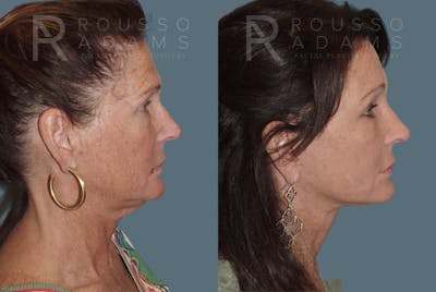 Facelift <span class=small>By Dr. Austin Adams</span> Before & After Gallery - Patient 146646993 - Image 2