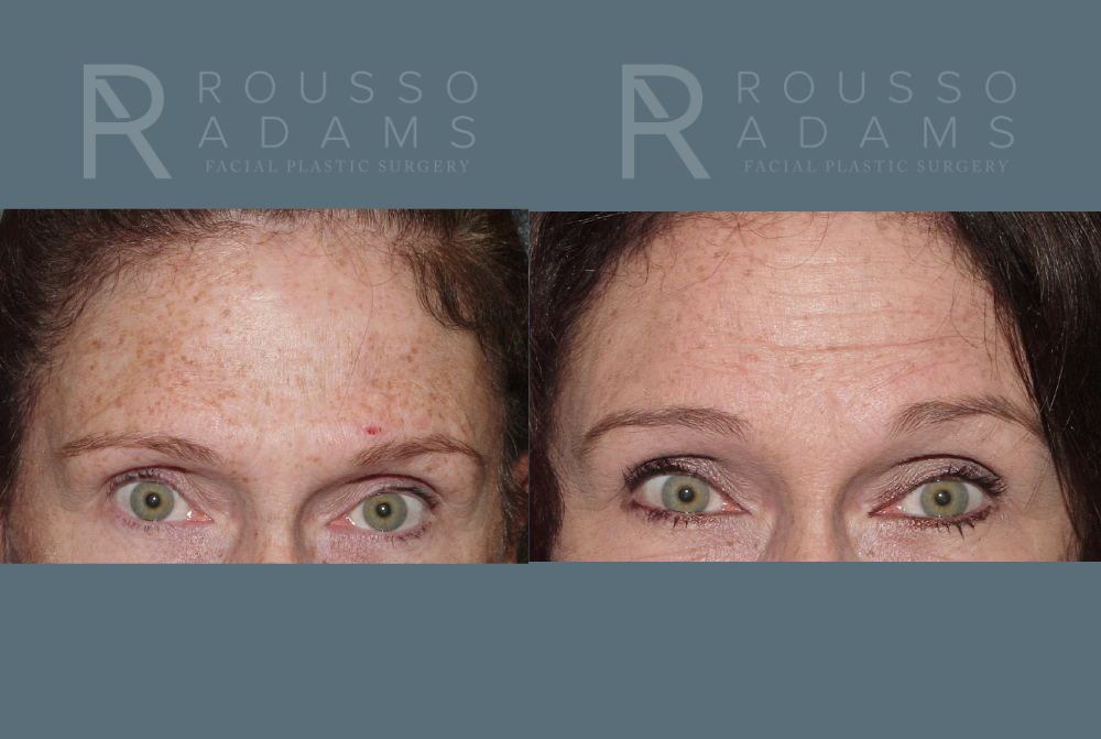 Facelift <span class=small>By Dr. Austin Adams</span> Before & After Gallery - Patient 146646993 - Image 3