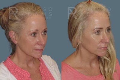 Facelift Before & After Gallery - Patient 146646994 - Image 1