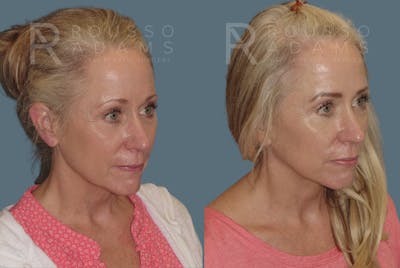 Facelift <span class=small>By Dr. Austin Adams</span> Before & After Gallery - Patient 146646994 - Image 1