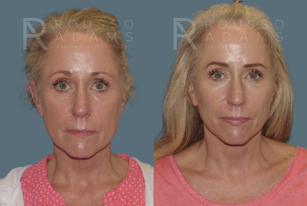 Facelift Before & After Gallery - Patient 146646994 - Image 2