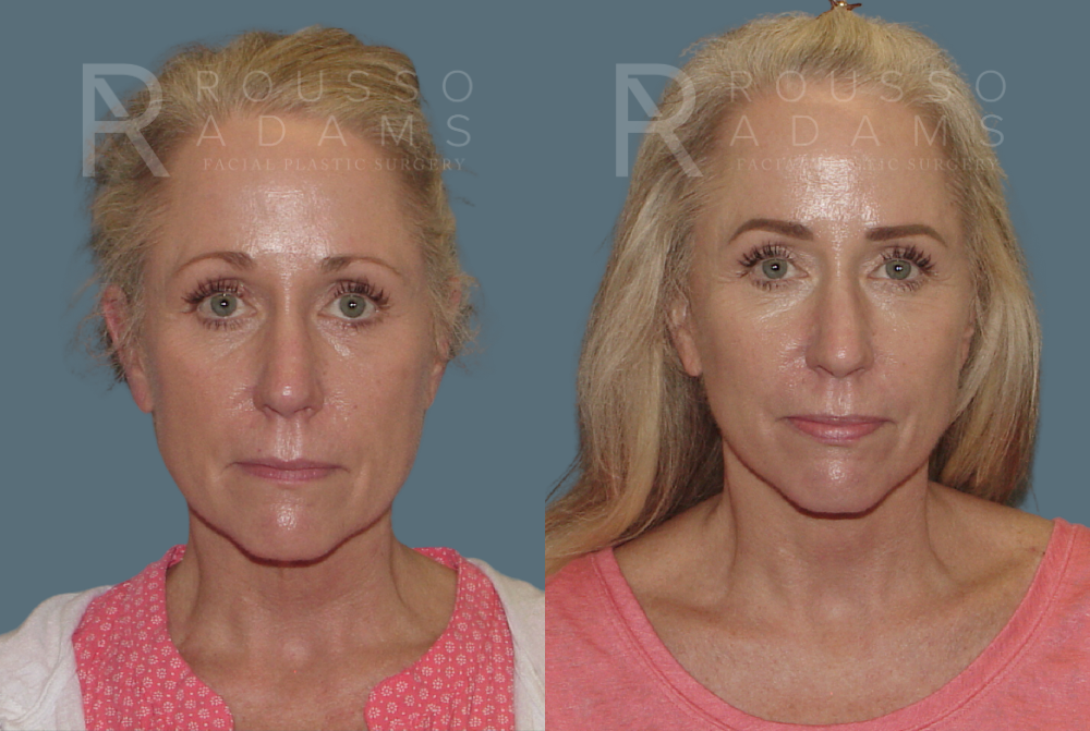 Facelift <span class=small>By Dr. Austin Adams</span> Before & After Gallery - Patient 146646994 - Image 2