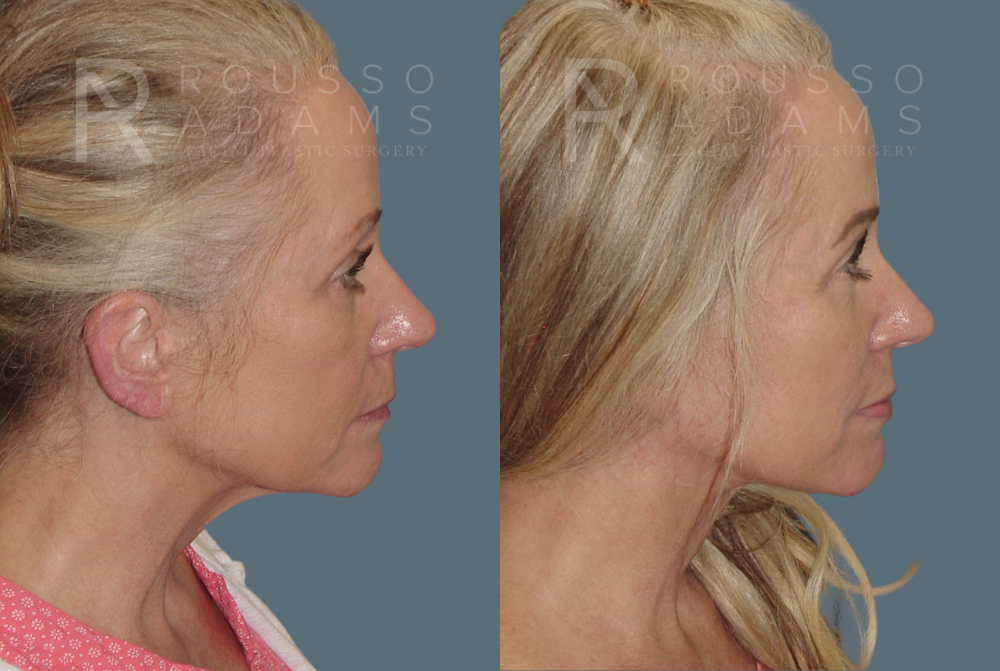Facelift <span class=small>By Dr. Austin Adams</span> Before & After Gallery - Patient 146646994 - Image 3