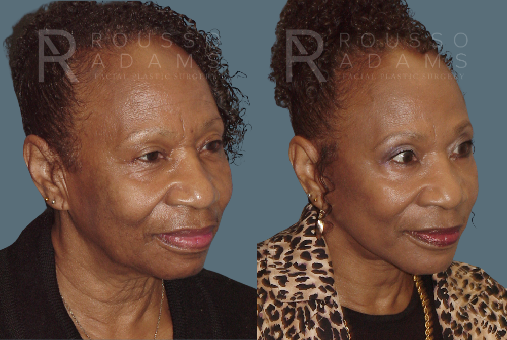 Facelift Before & After Gallery - Patient 146646995 - Image 1