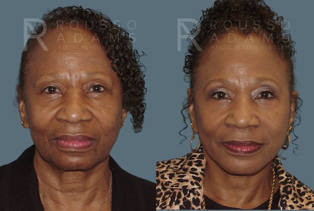 Before & After Image