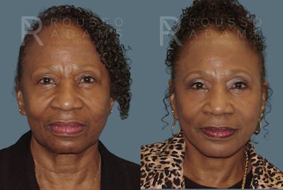 Facelift Before & After Gallery - Patient 146646995 - Image 2