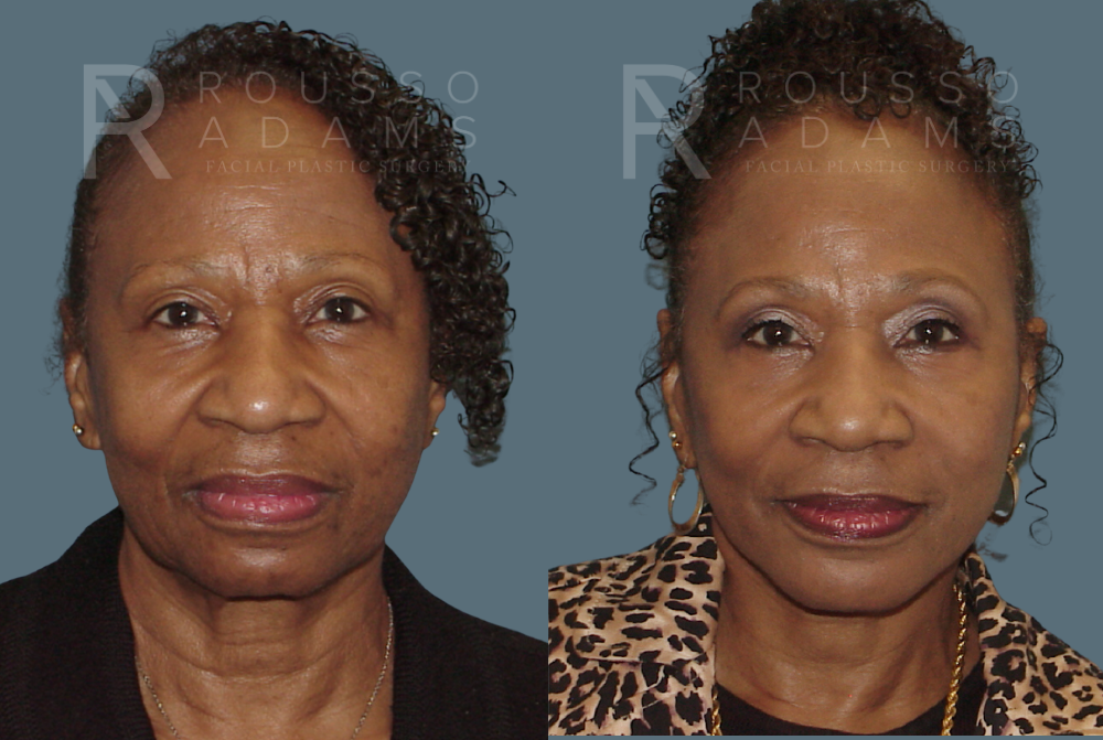SculptLift™<span class=small>By Dr. Austin Adams</span> Before & After Gallery - Patient 146647162 - Image 1