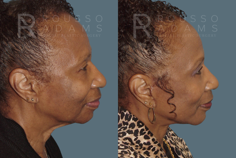 Facelift Before & After Gallery - Patient 146646995 - Image 3