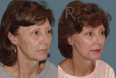 Facelift Before & After Gallery - Patient 146646996 - Image 1