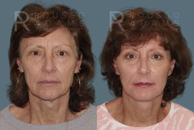 Facelift Before & After Gallery - Patient 146646996 - Image 2