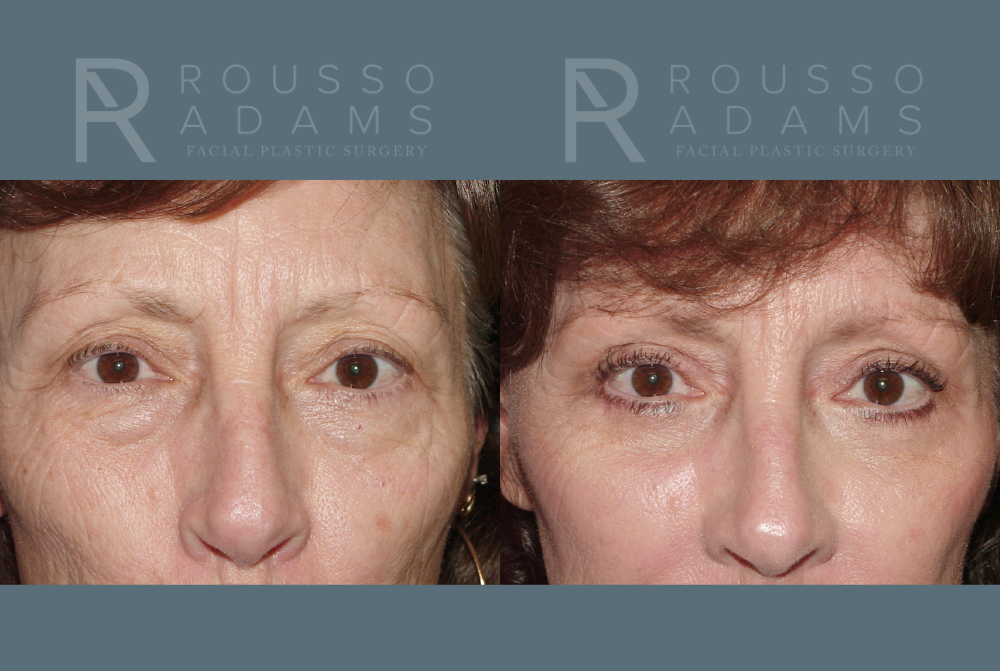 Facelift <span class=small>By Dr. Austin Adams</span> Before & After Gallery - Patient 146646996 - Image 3