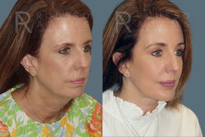 SculptLift™ Before & After Gallery - Patient 146647164 - Image 2