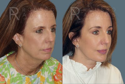 Facelift <span class=small>By Dr. Austin Adams</span> Before & After Gallery - Patient 146646997 - Image 1