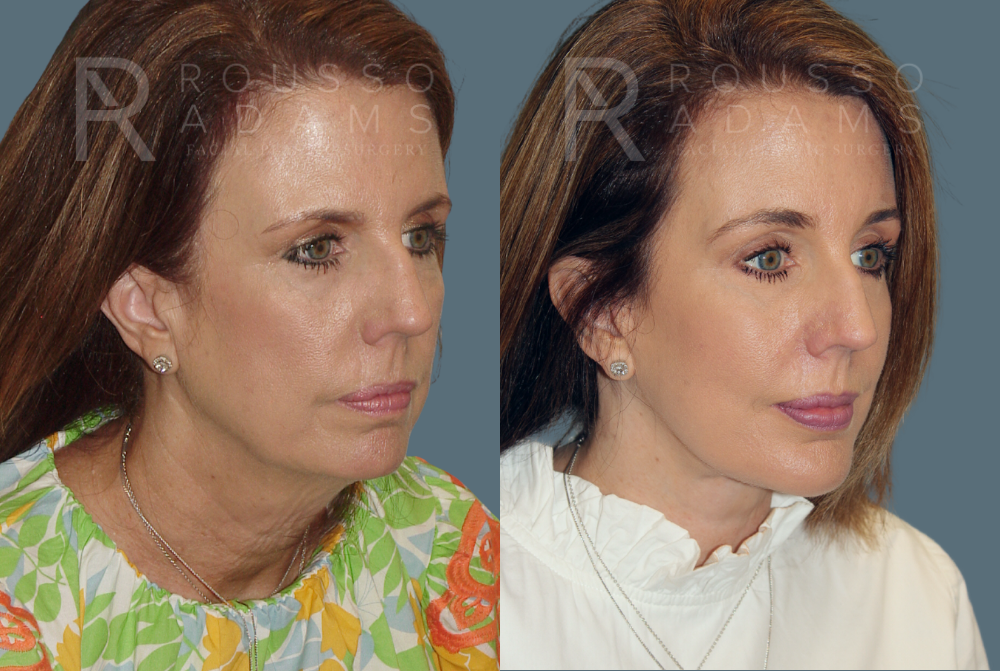 SculptLift™<span class=small>By Dr. Austin Adams</span> Before & After Gallery - Patient 146647164 - Image 2