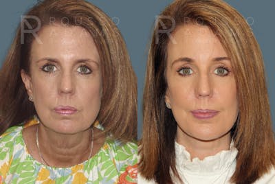 Facelift Before & After Gallery - Patient 146646997 - Image 2