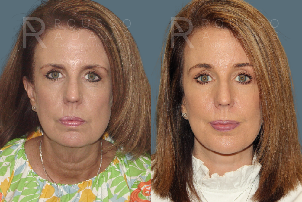 Facelift Before & After Gallery - Patient 146646997 - Image 2