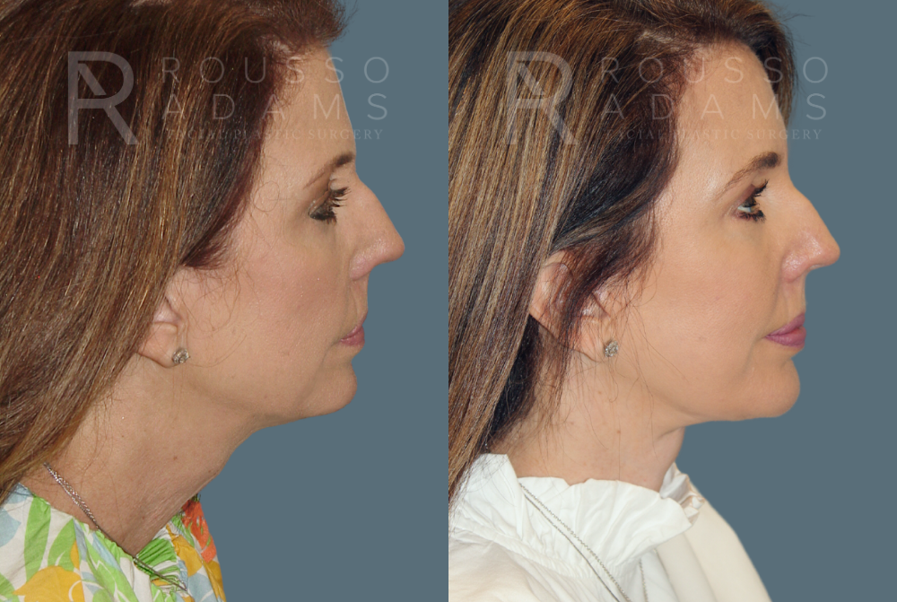 Facelift Before & After Gallery - Patient 146646997 - Image 3