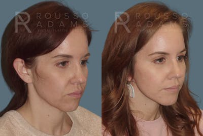 Facelift Before & After Gallery - Patient 146646998 - Image 1