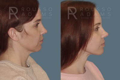 Facelift <span class=small>By Dr. Austin Adams</span> Before & After Gallery - Patient 146646998 - Image 2