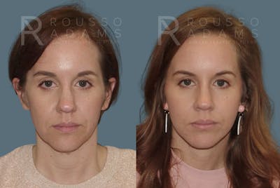 MiniLift<span class=small>By Dr. Austin Adams</span> Before & After Gallery - Patient 146647140 - Image 1