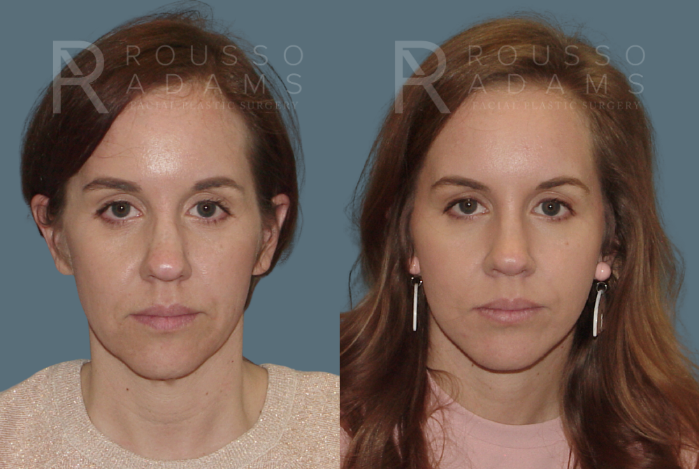 Facelift Before & After Gallery - Patient 146646998 - Image 3