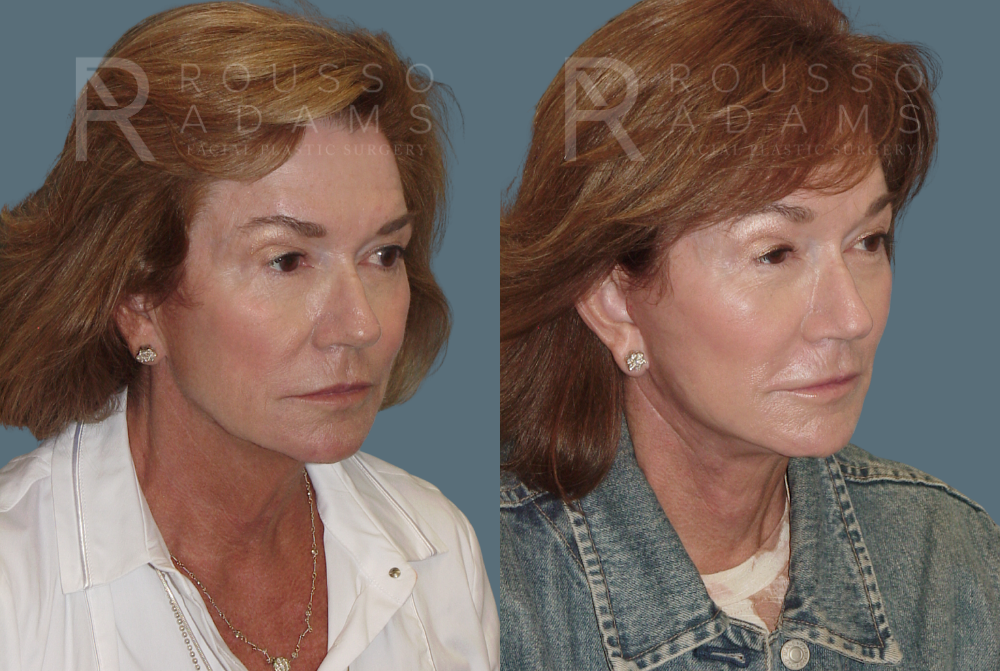 Facelift Before & After Gallery - Patient 146646999 - Image 1