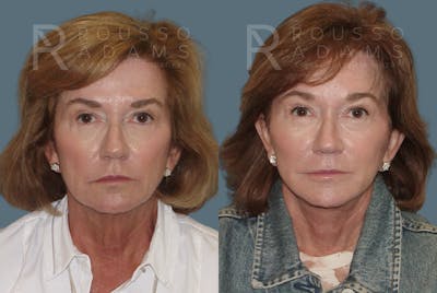 SculptLift™<span class=small>By Dr. Austin Adams</span> Before & After Gallery - Patient 146647165 - Image 1