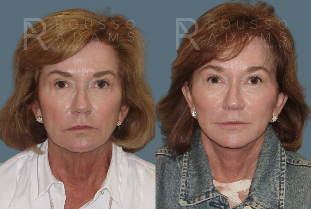 Facelift Before & After Gallery - Patient 146646999 - Image 2