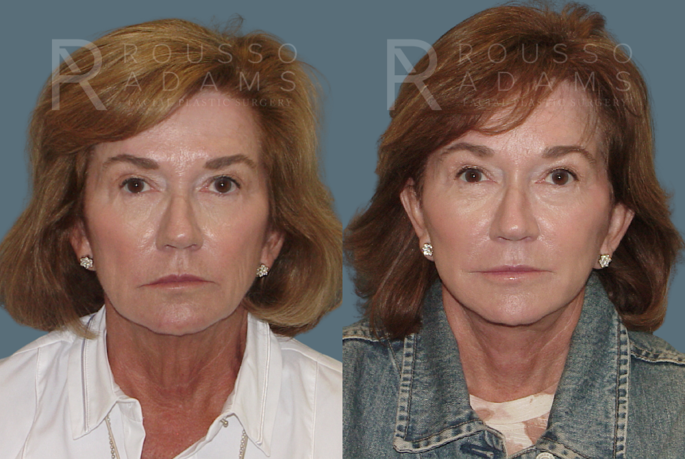SculptLift™<span class=small>By Dr. Austin Adams</span> Before & After Gallery - Patient 146647165 - Image 1