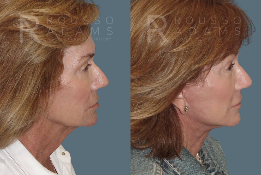 Facelift Before & After Gallery - Patient 146646999 - Image 3