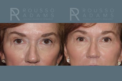 SculptLift™<span class=small>By Dr. Austin Adams</span> Before & After Gallery - Patient 146647165 - Image 4