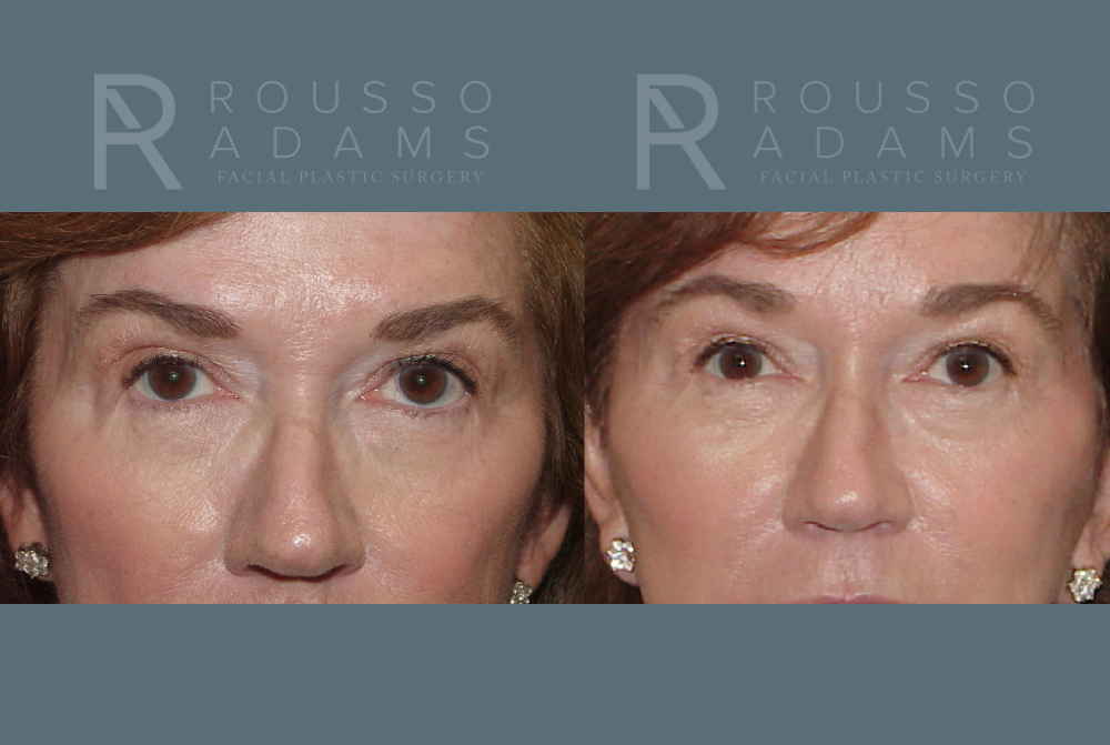 Facelift Before & After Gallery - Patient 146646999 - Image 4