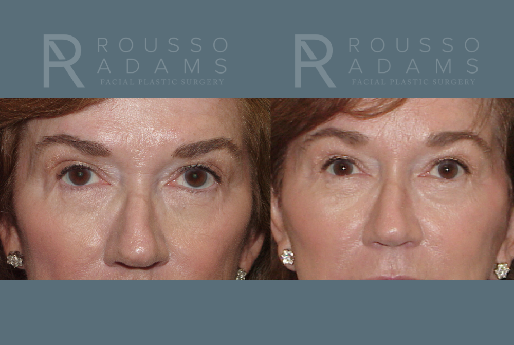 SculptLift™<span class=small>By Dr. Austin Adams</span> Before & After Gallery - Patient 146647165 - Image 4