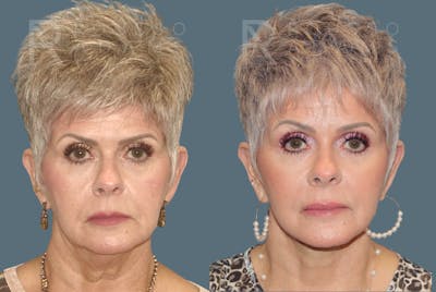 SculptLift™ Before & After Gallery - Patient 146647166 - Image 1