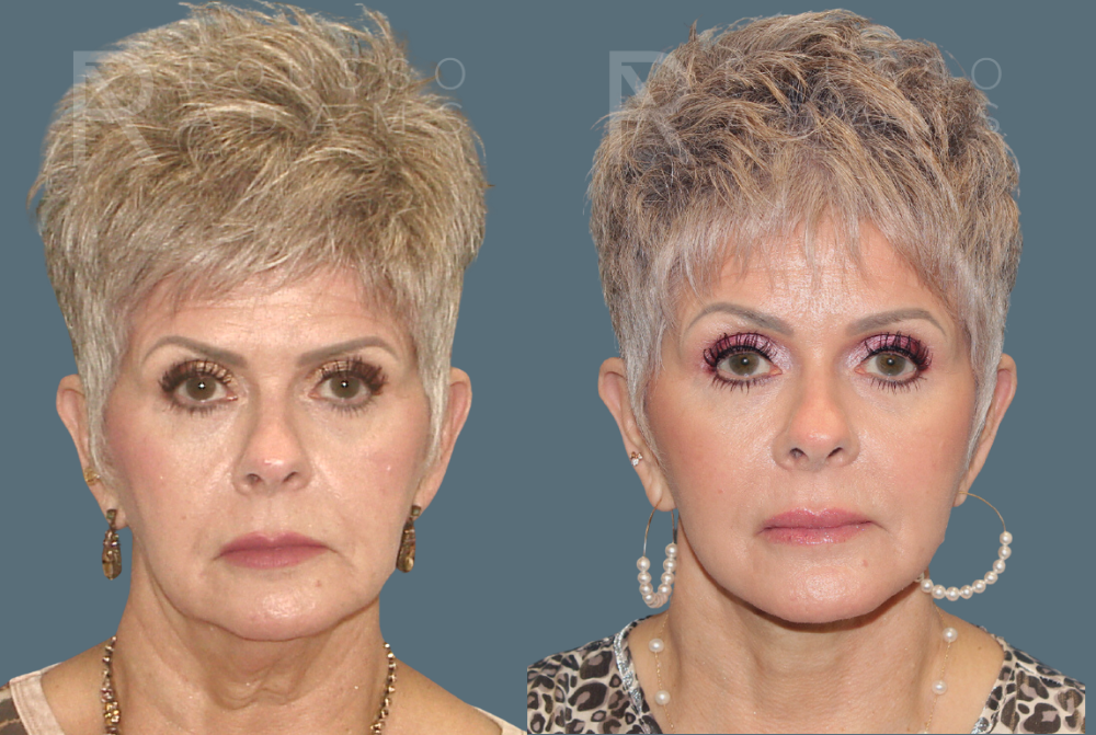 Facelift Before & After Gallery - Patient 146647000 - Image 2