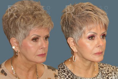 Facelift Before & After Gallery - Patient 146647000 - Image 1