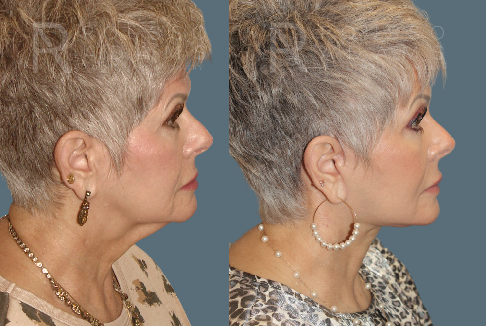 Facelift Before & After Gallery - Patient 146647000 - Image 3