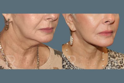 SculptLift™<span class=small>By Dr. Austin Adams</span> Before & After Gallery - Patient 146647166 - Image 4