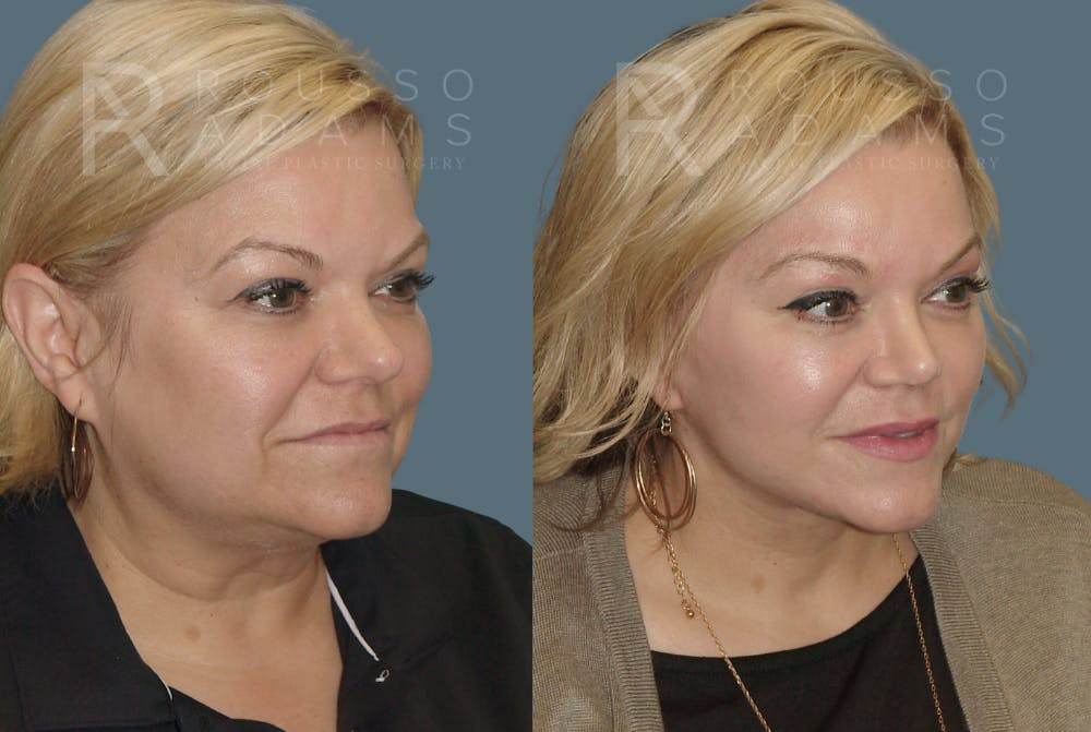 Before & After Image