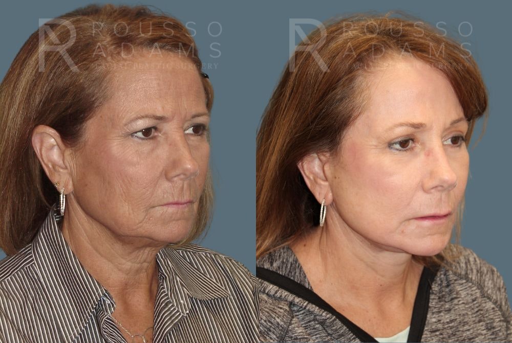 Facelift <span class=small>By Dr. Austin Adams</span> Before & After Gallery - Patient 146646987 - Image 1