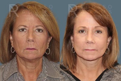 Facelift Before & After Gallery - Patient 146646987 - Image 2