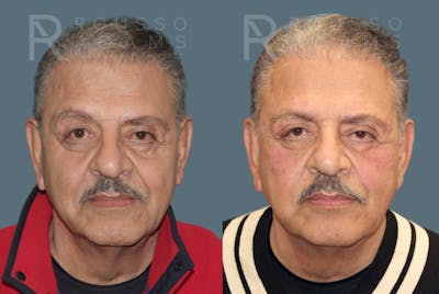 Fillers Before & After Gallery - Patient 146803837 - Image 4