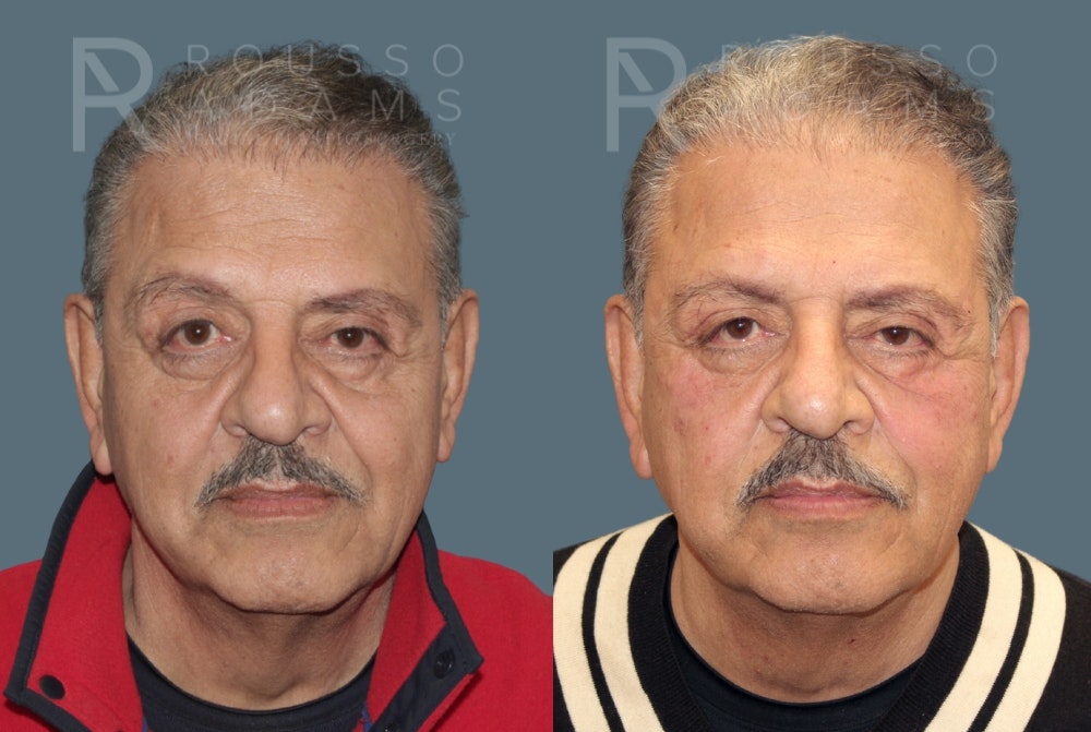 Fillers Before & After Gallery - Patient 146803837 - Image 4