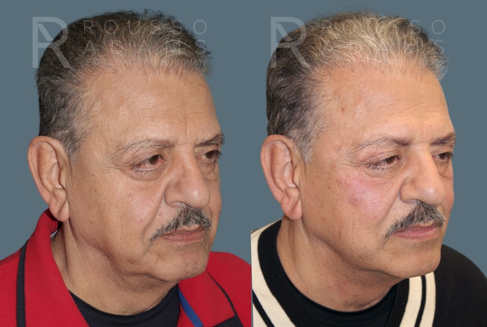 Fillers Before & After Gallery - Patient 146803837 - Image 5