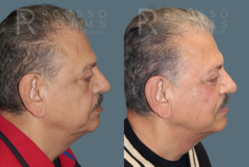 Fillers Before & After Gallery - Patient 146803837 - Image 6