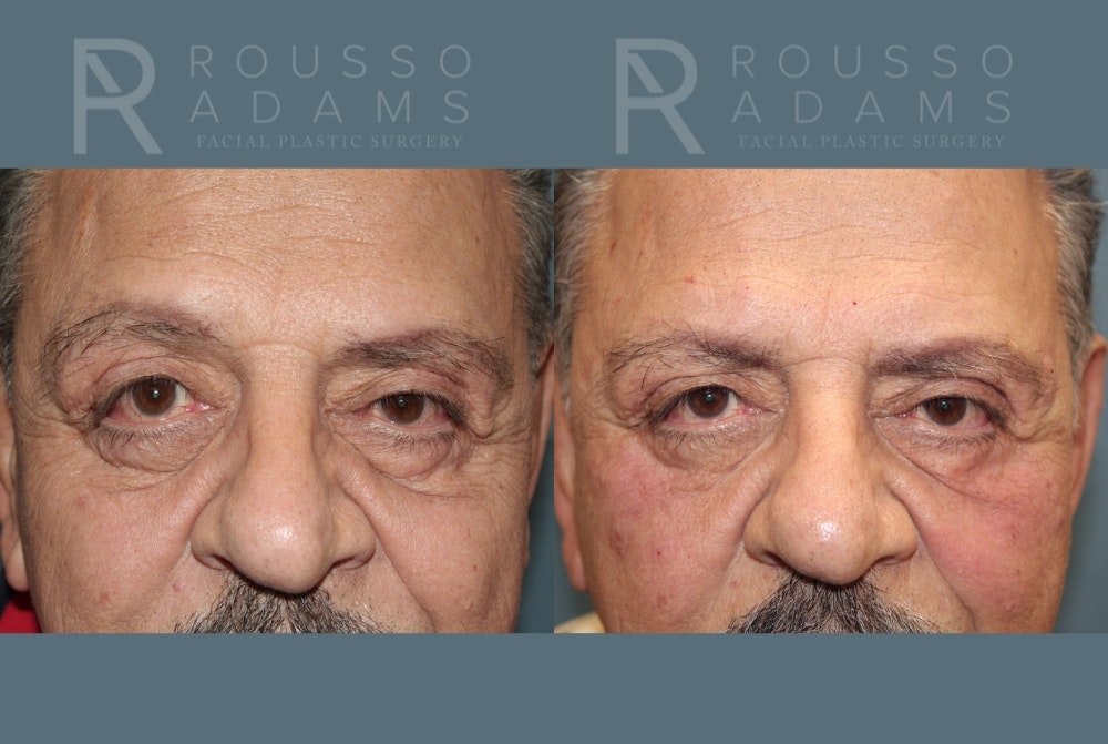 Fillers Before & After Gallery - Patient 146803837 - Image 1