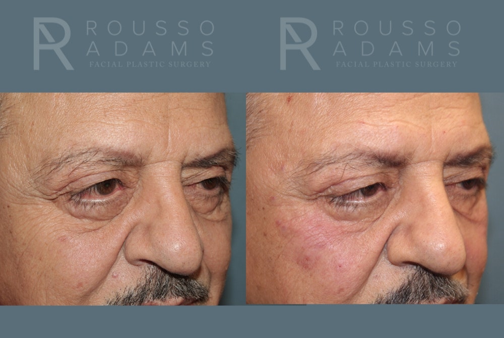 Fillers Before & After Gallery - Patient 146803837 - Image 2