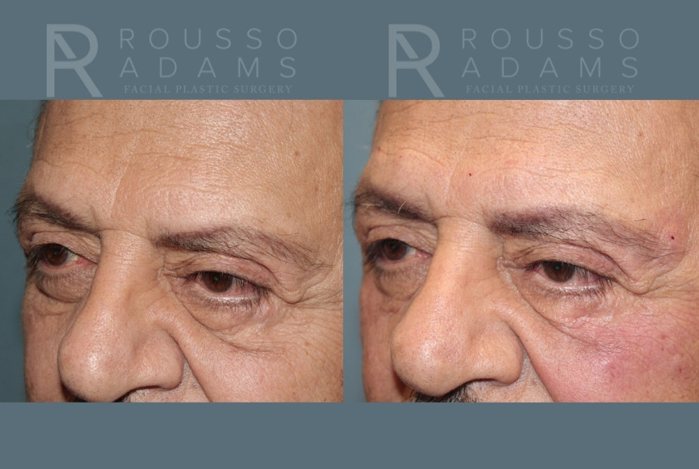 Fillers Before & After Gallery - Patient 146803837 - Image 3