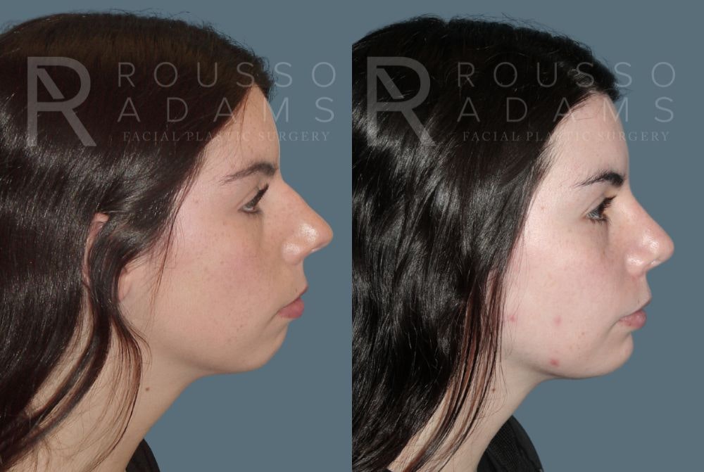 Facial Implants Before & After Gallery - Patient 147124256 - Image 1
