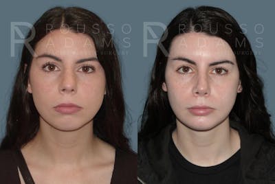 Facial Implants Before & After Gallery - Patient 147124256 - Image 2